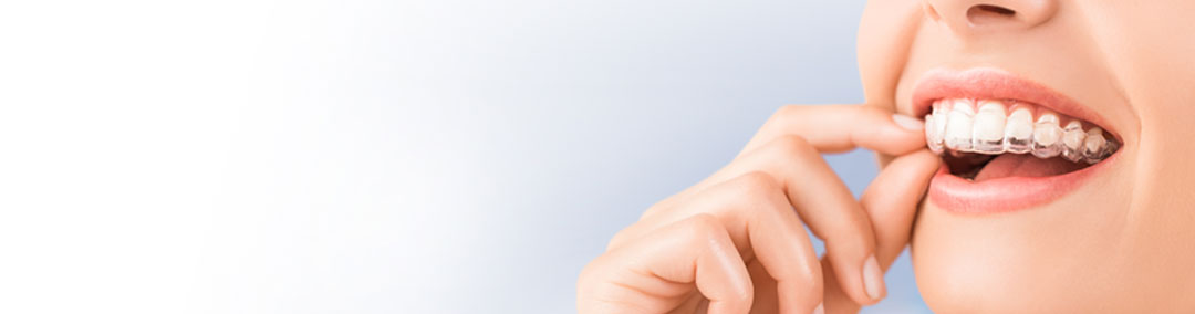 Invisalign-header